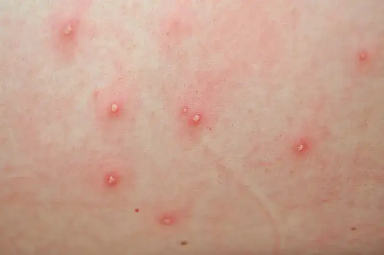 Objawy ospy wietrznej: jak je rozpoznać i uniknąć powikłań