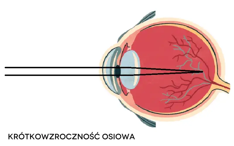 Czy wada wzroku minus może się cofnąć: Prawda o leczeniu krótkowzroczności