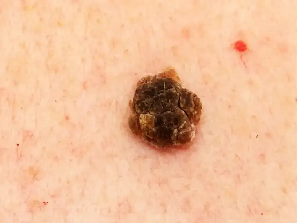 Brodawka łojotokowa - czy może odpaść? Fakty i mity