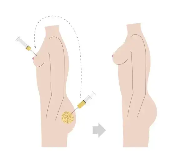 Lipofilling biustu – czy warto? Opinie i doświadczenia kobiet.