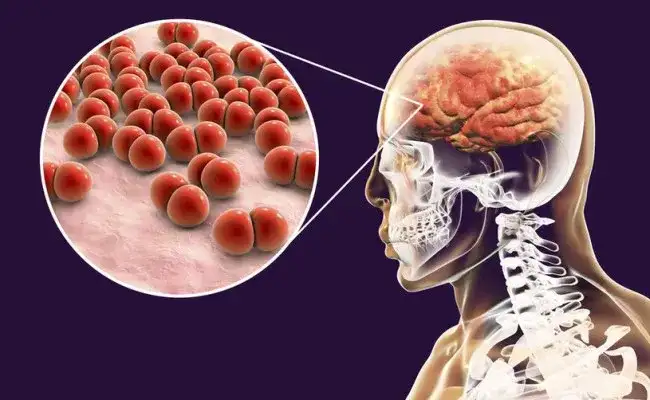 Czyraki przyczyna: Jak bakterie mogą zagrażać twojemu zdrowiu?