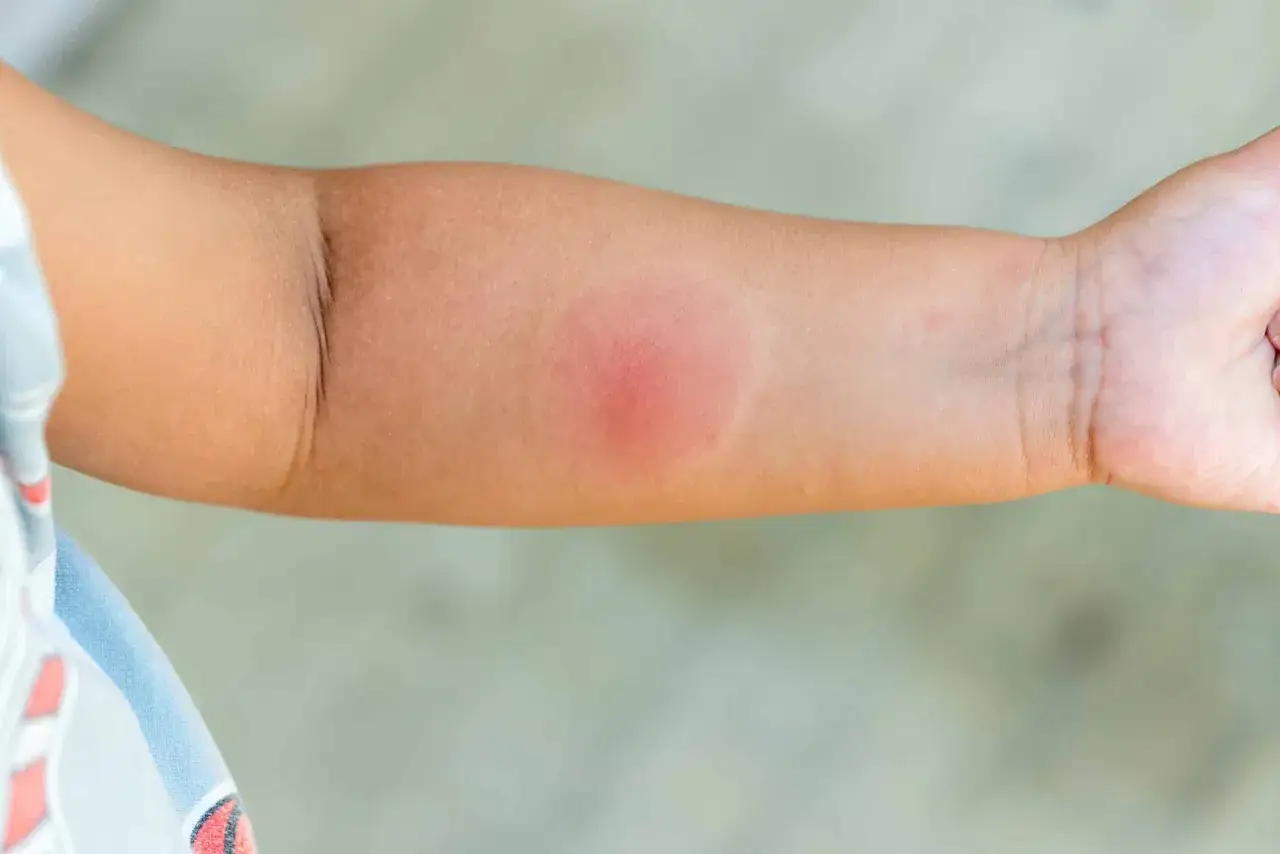 Bras d'enfant avec une rougeur circulaire et enfl&eacute;e, signe d'une piqure de moustique infect&eacute;e.