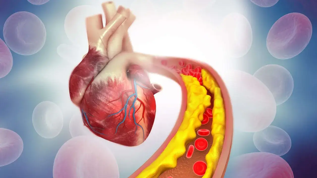 Herz mit Arterienverkalkung. Gelbe Ablagerungen verengen das Blutgefäß, was die Lebenserwartung bei Arteriosklerose beeinflusst. Rote Blutkörperchen kämpfen sich durch.