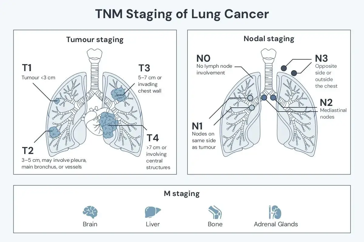 Schema zur Lungenkrebs-Stadieneinteilung (TNM). Zeigt Tumorgr&ouml;&szlig;e, Lymphknotenbefall und Fernmetastasen (Gehirn, Leber, Knochen, Nebennieren). Fr&uuml;hzeitige Diagnose ist entscheidend, ob man Lungenkrebs heilen kann.