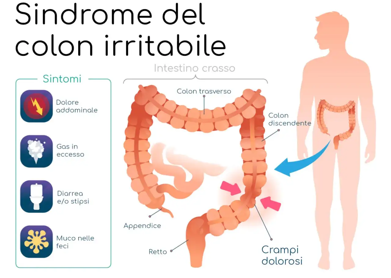 Illustrazione della sindrome del colon irritabile, con sintomi come dolore addominale, gas, diarrea/stipsi e muco. Evidenziati crampi dolorosi.