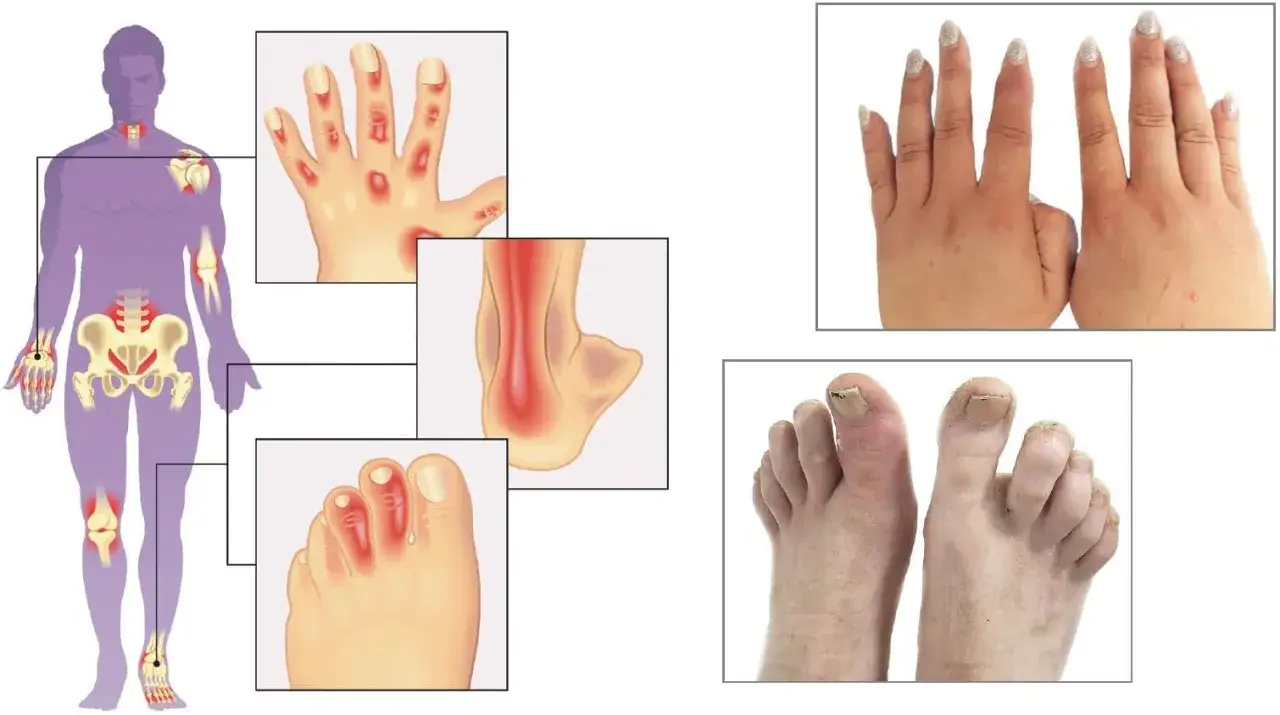 Illustration zeigt Gelenkentz&uuml;ndungen bei Psoriasis-Arthritis. Betroffene Gelenke an H&auml;nden, F&uuml;&szlig;en, Knien, Kn&ouml;cheln und der Wirbels&auml;ule. Dies kann die Rente beeinflussen.