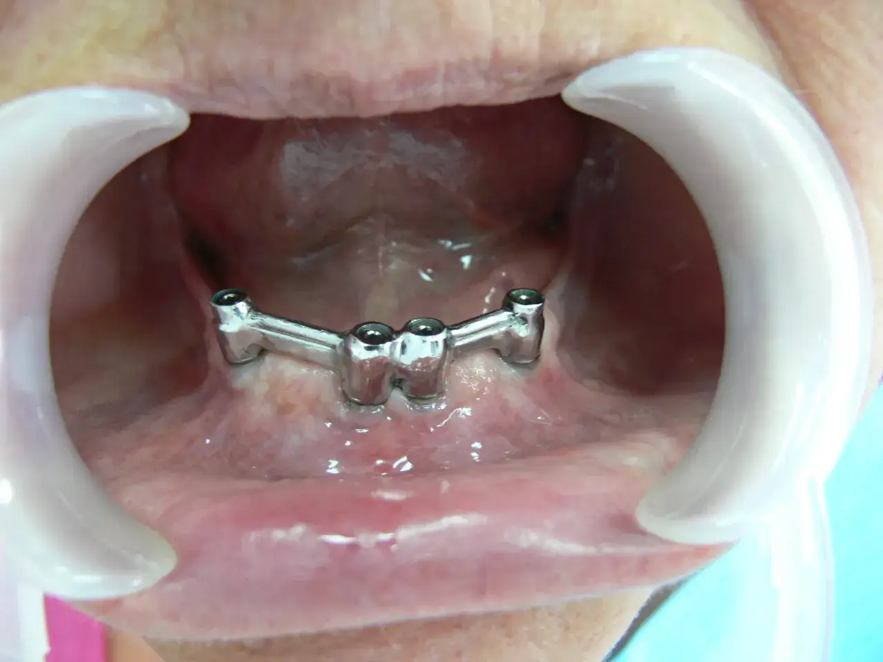 Metalowa proteza na belce, zamocowana na implantach, przygotowana do dalszego leczenia.