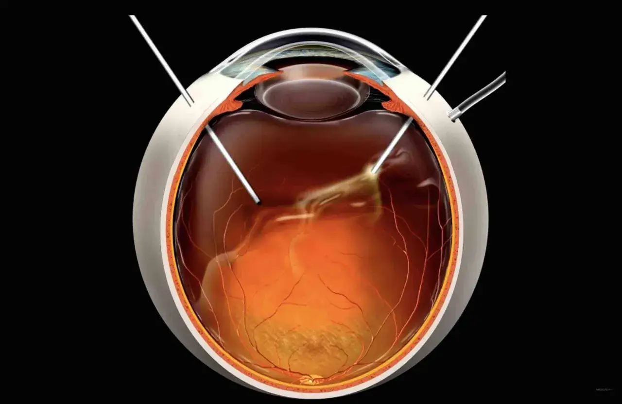Illustrazione di una vitrectomia, procedura chirurgica oculare. Si vedono strumenti che entrano nell'occhio. I vitrectomia rischi sono da considerare.