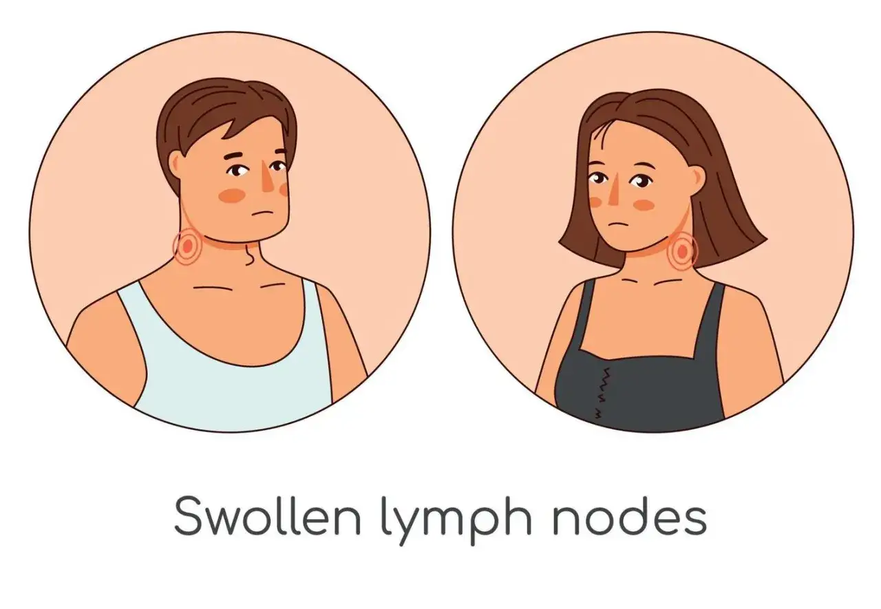 Ilustracja pokazuje mężczyznę i kobietę z widocznymi, zaczerwienionymi kółkami wokół szyi, symbolizującymi powiększone węzły chłonne.