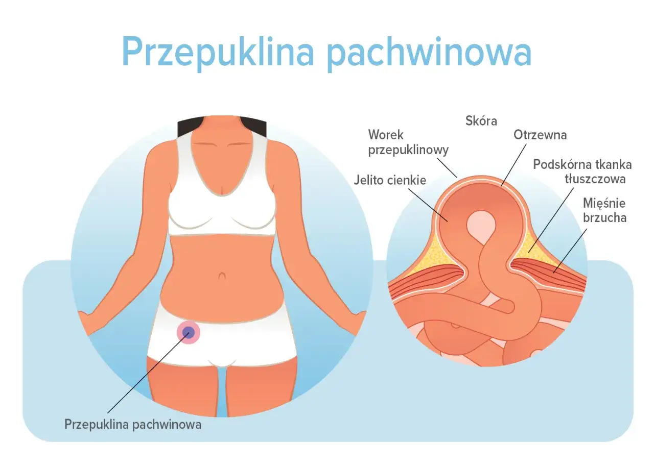 Ilustracja przedstawia przepuklinę pachwinową u kobiety, z zaznaczonymi objawami i przekrojem anatomicznym pokazującym jelito cienkie w worku przepuklinowym.