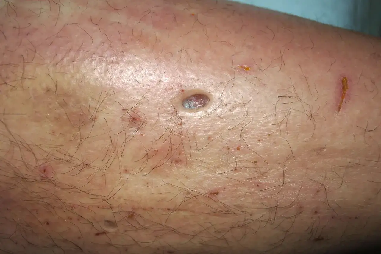 Skóra nogi z widocznymi zmianami, w tym owrzodzeniem, zaczerwienieniem i drobnymi krostkami, sugerującymi trądzik neuropatyczny.