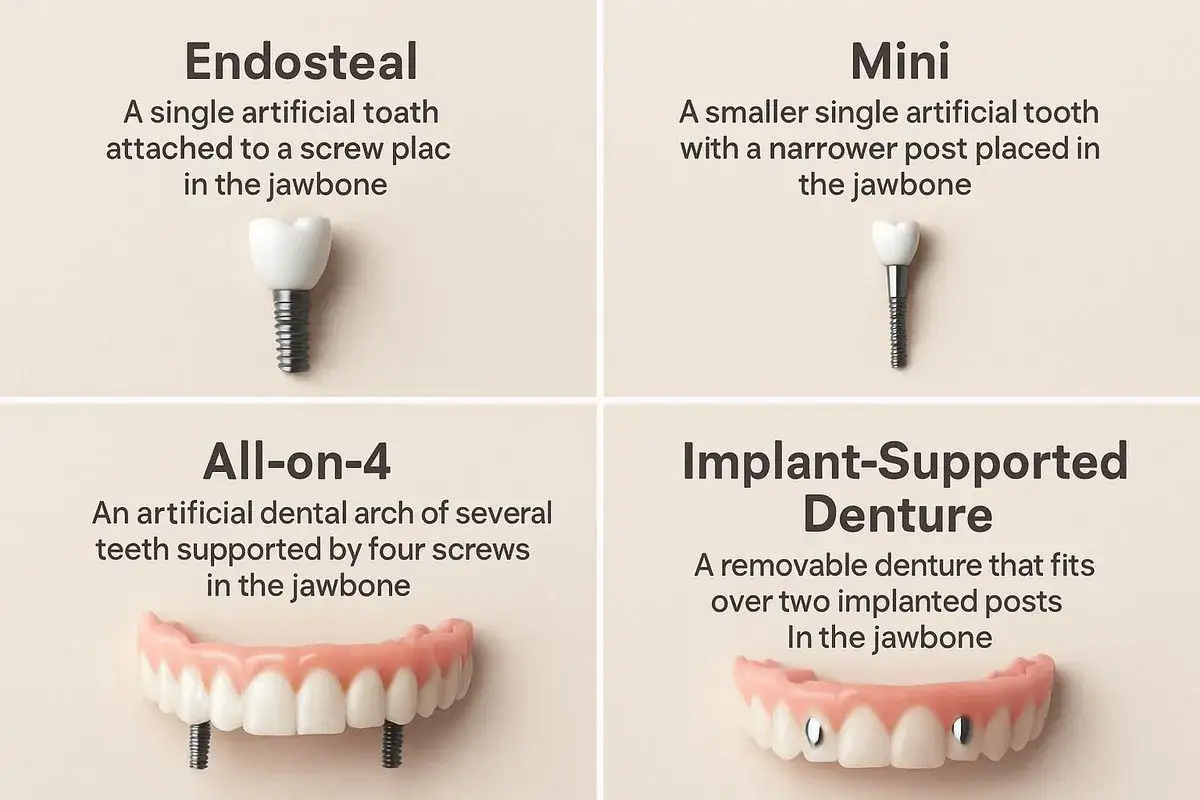 Rodzaje implant&oacute;w zębowych: endostealny, mini, All-on-4 i proteza wsparta na implantach. Unikaj dyskomfortu z powodu uwierającej protezy zębowej.
