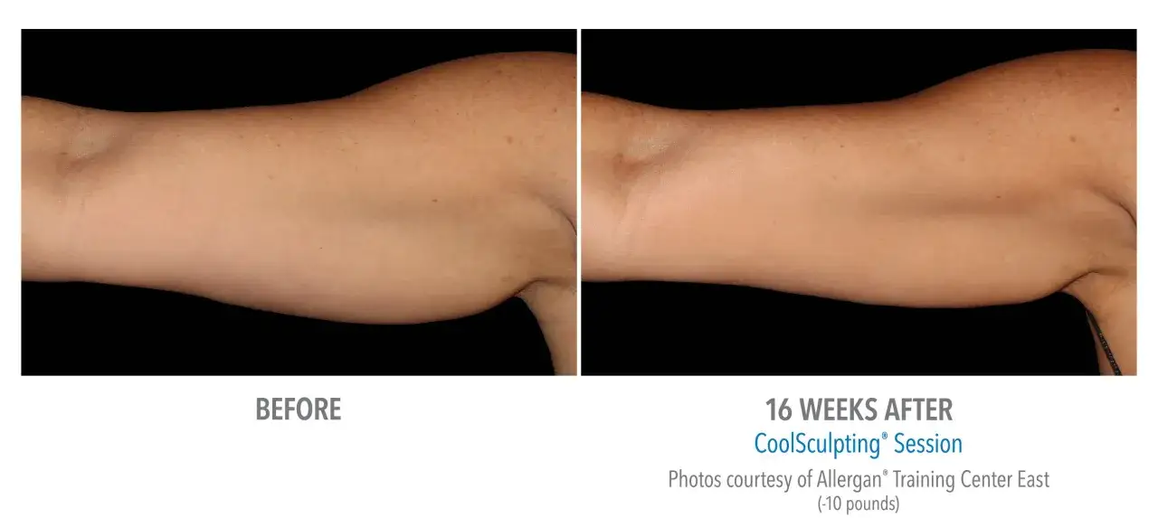 Före- och efterbilder på armar som visar resultat av CoolSculpting. Armarna ser slankare ut efter 16 veckor.