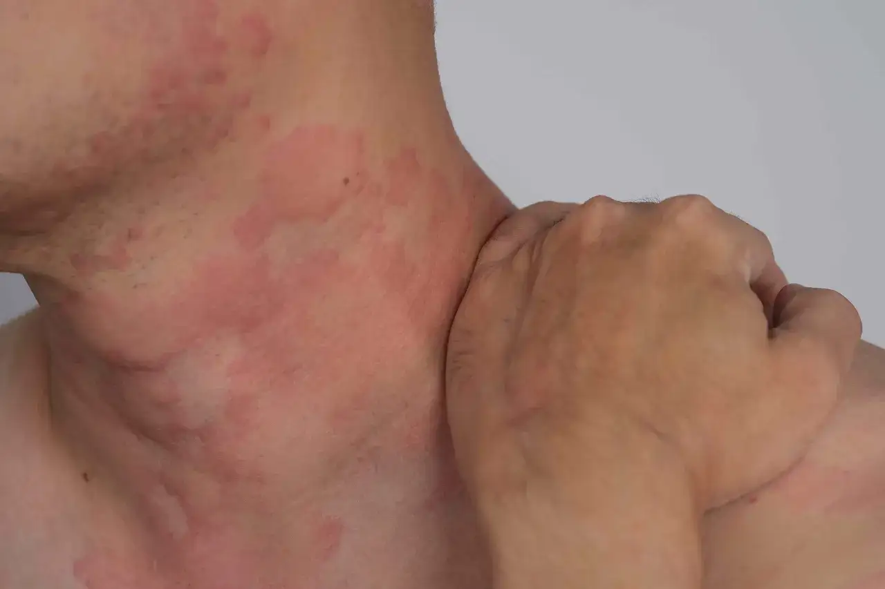 Pelle arrossata e irritata sul collo e sulla spalla, sintomi di dermatite da stress.