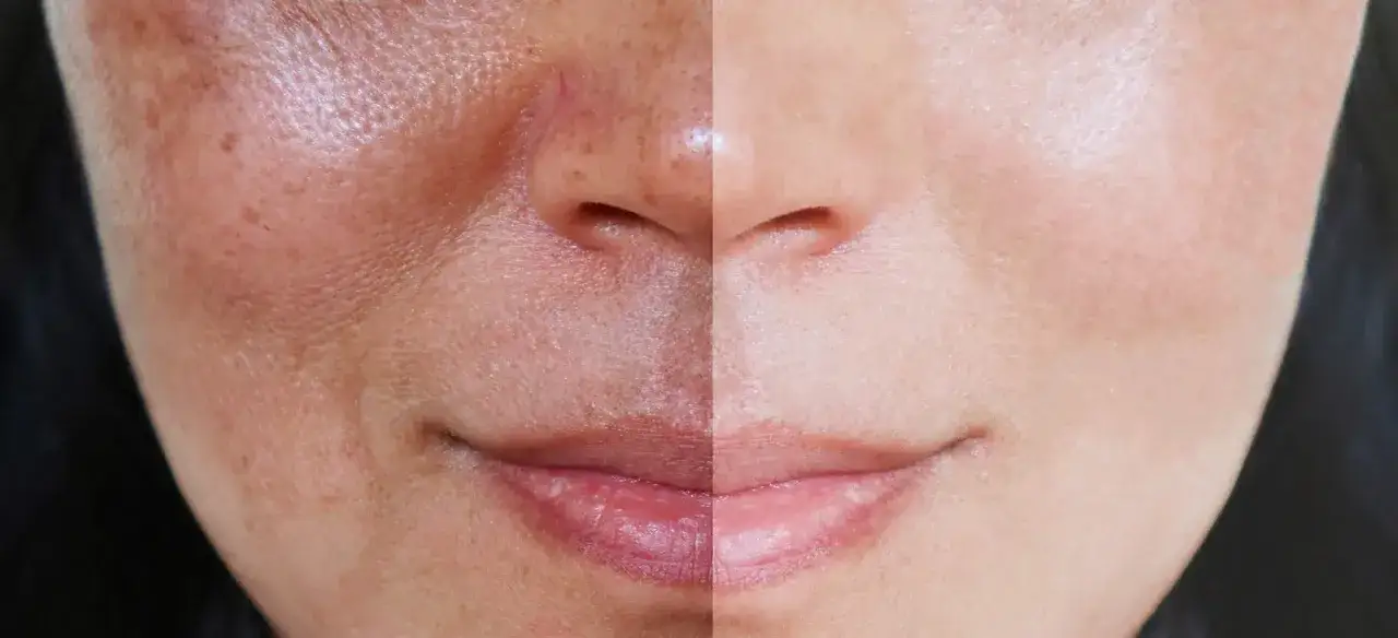 Comparaison avant/après : une moitié du visage montre une peau marquée par une tache de soleil, l'autre moitié une peau nette et lumineuse.