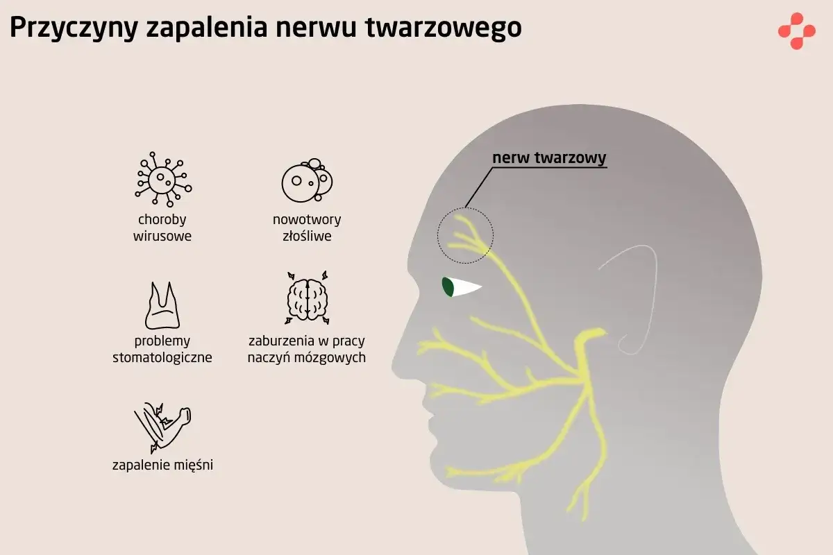 Ilustracja przedstawia przyczyny zapalenia nerwu twarzowego, w tym neuralgia nerwu trójdzielnego, choroby wirusowe, nowotwory, problemy stomatologiczne, zaburzenia naczyń mózgowych i zapalenie mięśni.