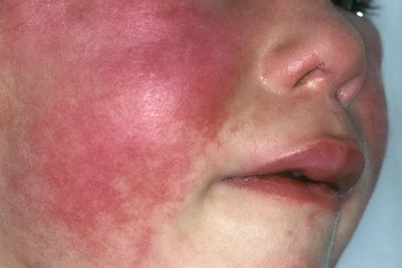 Viso di bambino con arrossamento diffuso e macchie rosse, possibili puntini scarlattina inizio.