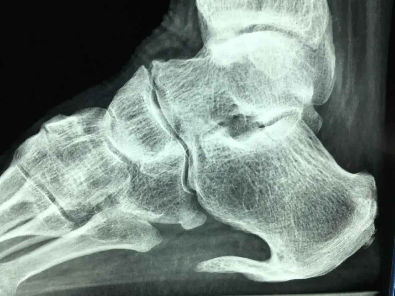 Radiografia laterale del piede che mostra un evidente sperone calcaneare, una crescita ossea sulla parte inferiore del calcagno.