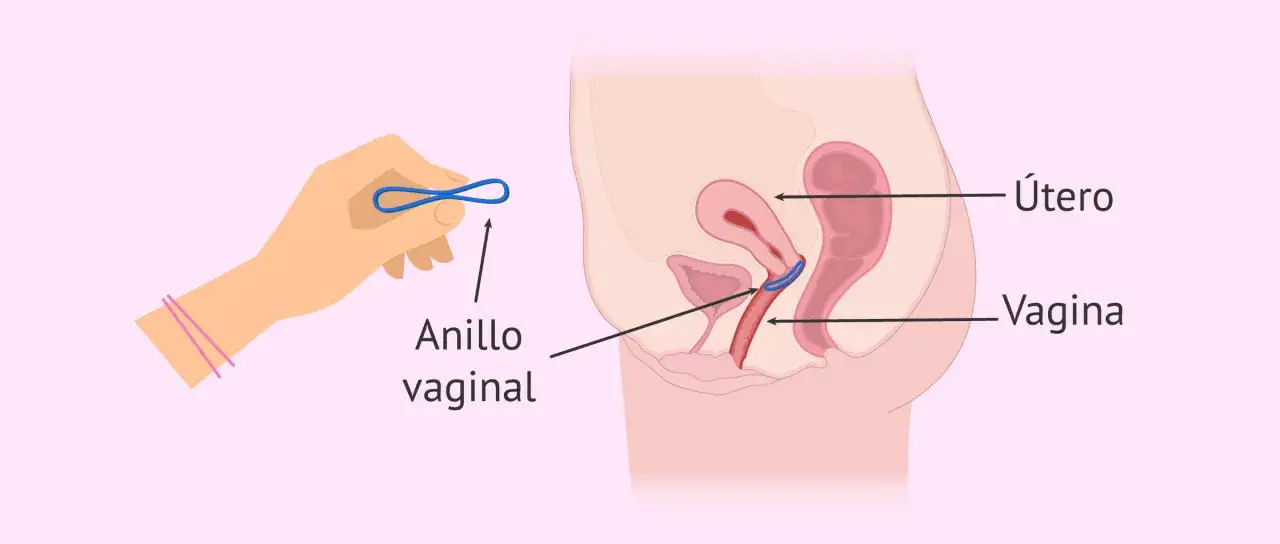 Ilustraci&oacute;n muestra c&oacute;mo quitar el anillo anticonceptivo de la vagina.
