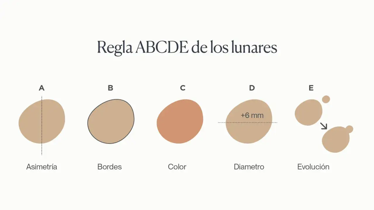 Regla ABCDE para identificar lunares malignos: Asimetría, Bordes irregulares, Color variado, Diámetro mayor a 6 mm y Evolución.
