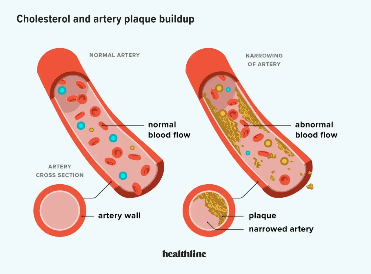 Porównanie zdrowej tętnicy z tętnicą zwężoną przez blaszkę miażdżycową, spowodowaną m.in. przez podwyższony cholesterol LDL.