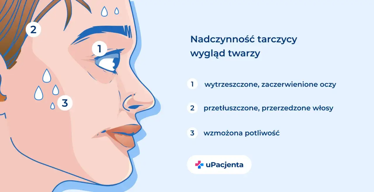 Nadczynność tarczycy: wytrzeszczone oczy, przetłuszczone włosy i wzmożona potliwość. Objawy te mogą być mylone z problemami z niskim TSH.