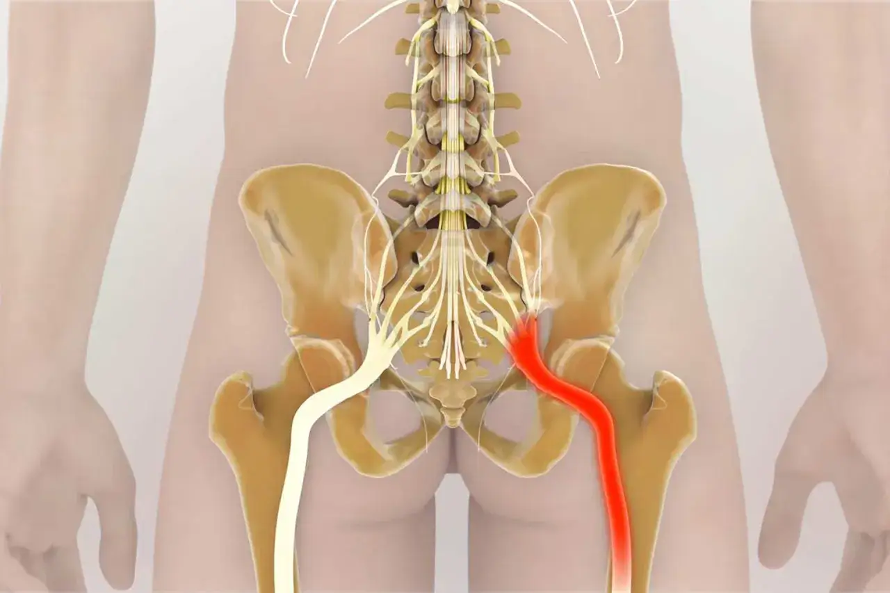 Illustrazione anatomica del nervo sciatico della gamba sinistra, evidenziato in rosso per indicare un'irritazione o infiammazione.