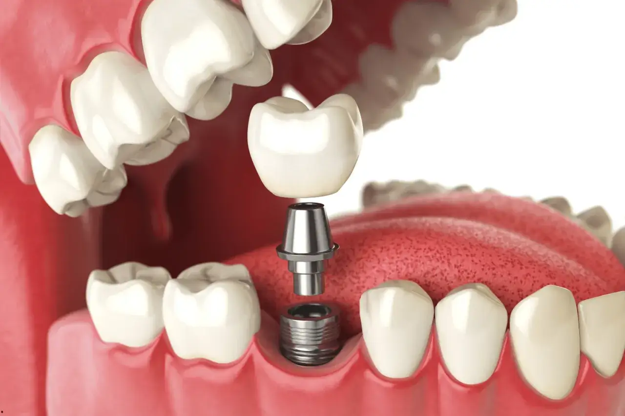 Detalle de una **implantación dental**: corona, pilar y tornillo listos para ser ensamblados en la encía.