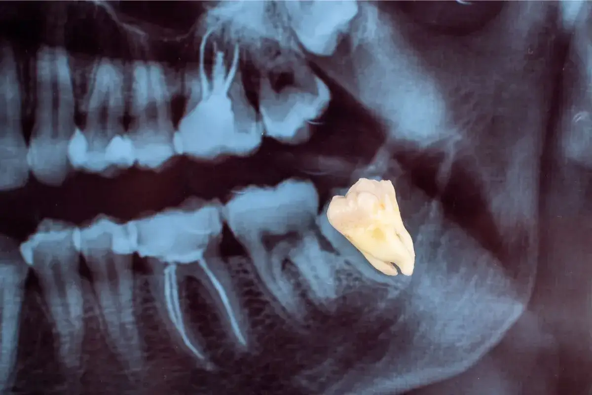 Radiograf&iacute;a dental muestra una muela del juicio extra&iacute;da, con sus ra&iacute;ces curvas y un aspecto amarillento.