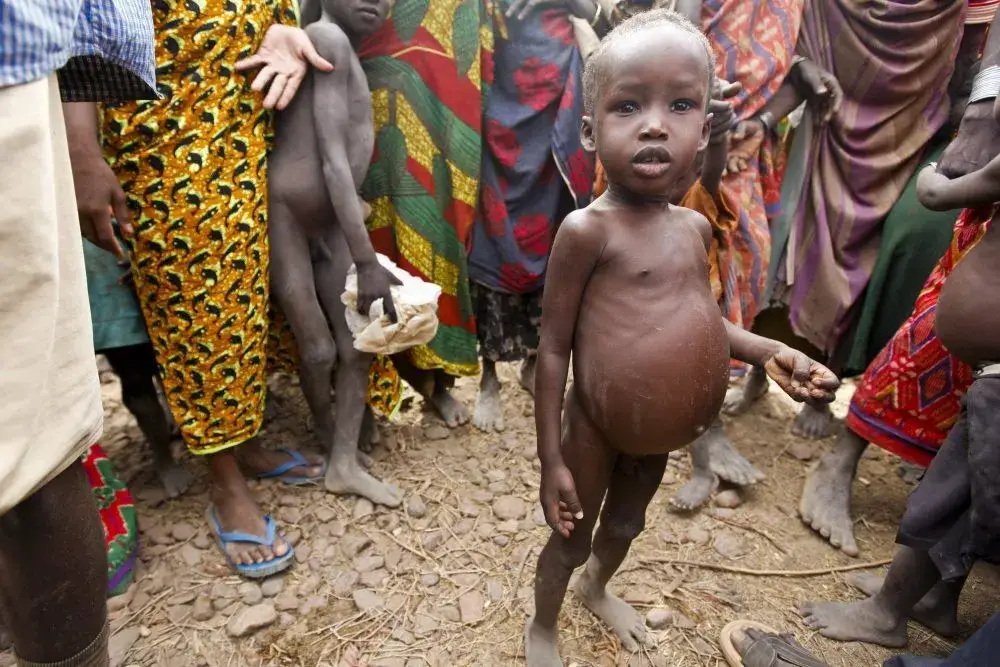 dzieci w Afryce z dużymi brzuchami, Kwashiorkor