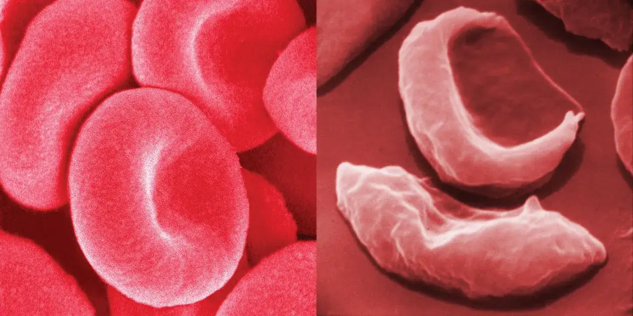 Comparación de glóbulos rojos sanos y deformados, mostrando la forma de hoz característica de la anemia de células falciformes.