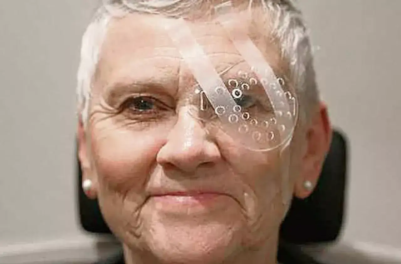 Kobieta z plastrem na oku po witrektomii. Przezroczysta osłonka z otworami chroni oko.