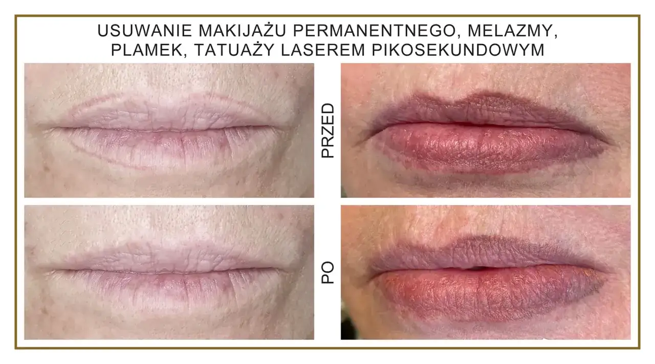 Przed i po laserowym usuwaniu nieudanego makijażu permanentnego ust. Widoczne zmiany koloru i konturu warg.