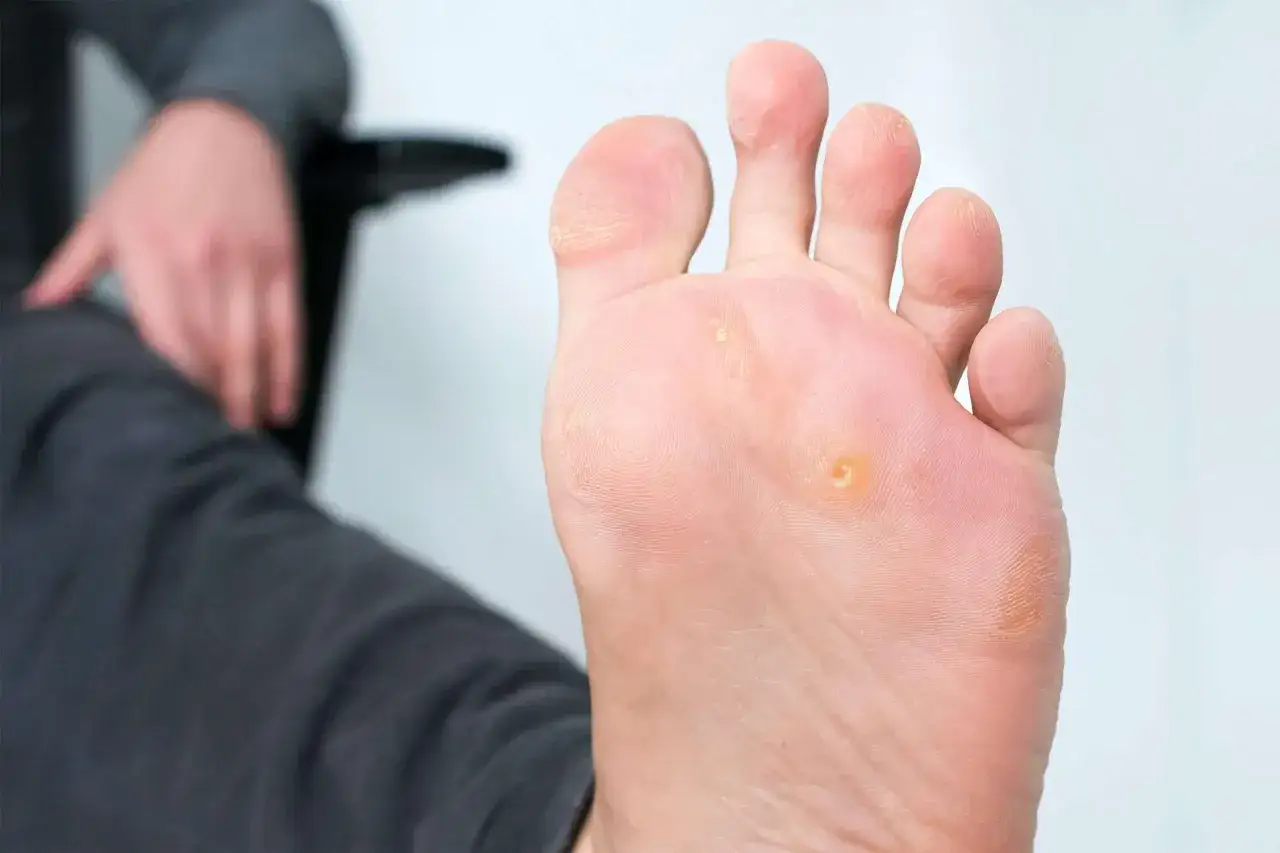 Un pied présente des cors, notamment un cors au pied bien visible sous la plante. La personne semble s'apprêter à soigner cette affection.