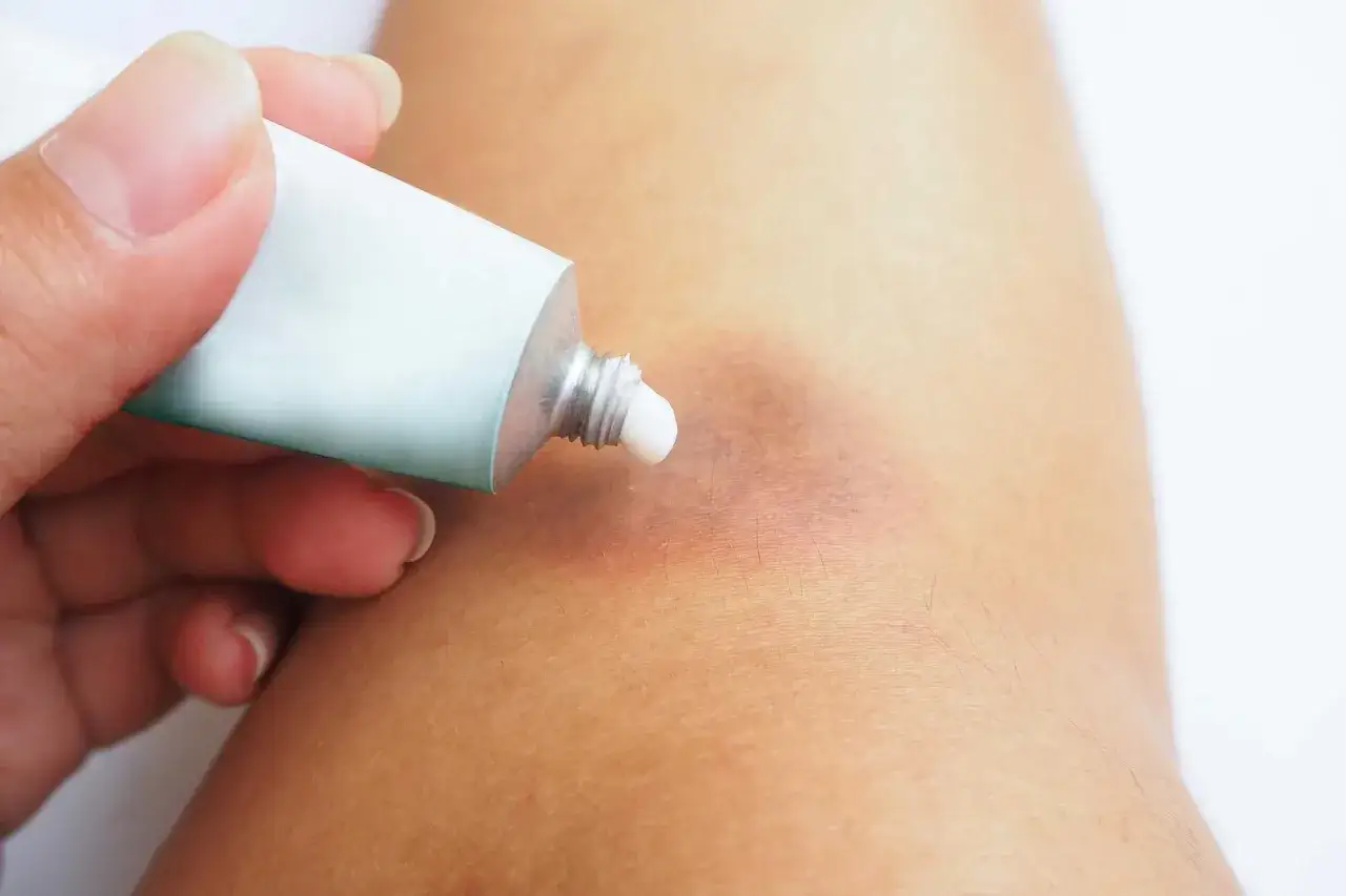 Arnika gegen blaue Flecken: Eine Hand drückt eine Salbentube aus, um eine weiße Creme auf einen blauen Fleck auf der Haut aufzutragen.