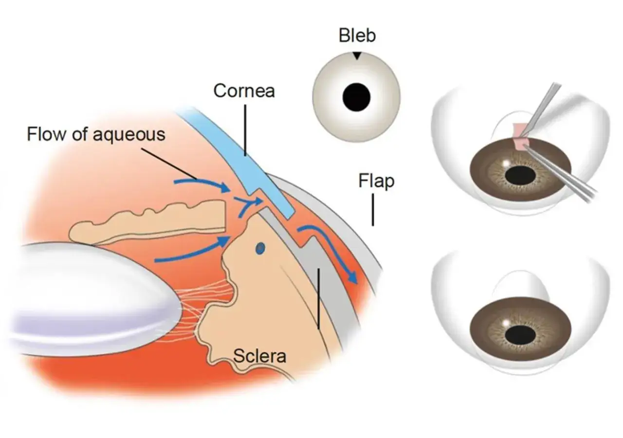 Illustrazione del trabeculectomia decorso post operatorio: flusso acquoso attraverso lembo e sclera, formazione di bleb.