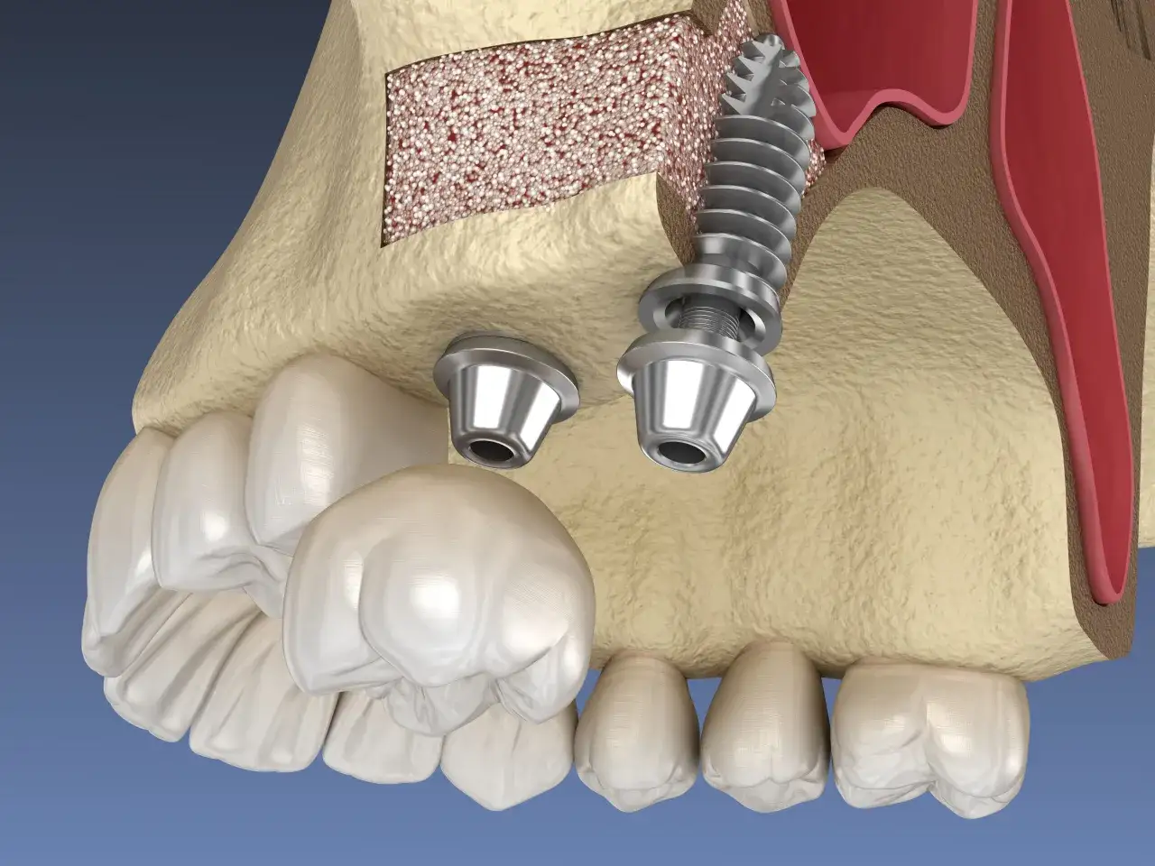 Model szczęki z implantami i materiałem kostnym, ilustrujący zabieg sinus lift.