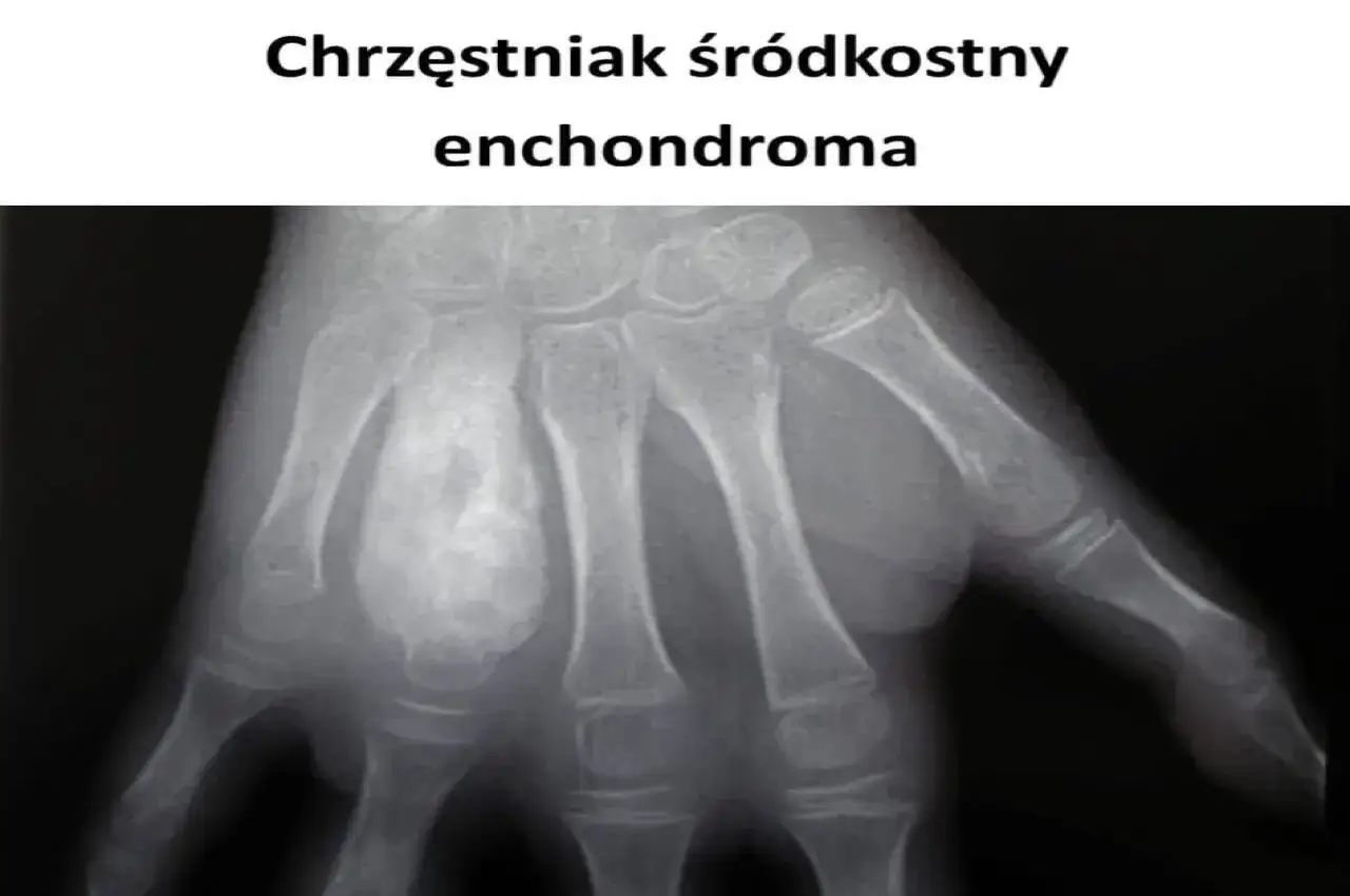RTG dłoni z widocznym chrzęstniakiem śródkostnym w kości śródręcza.