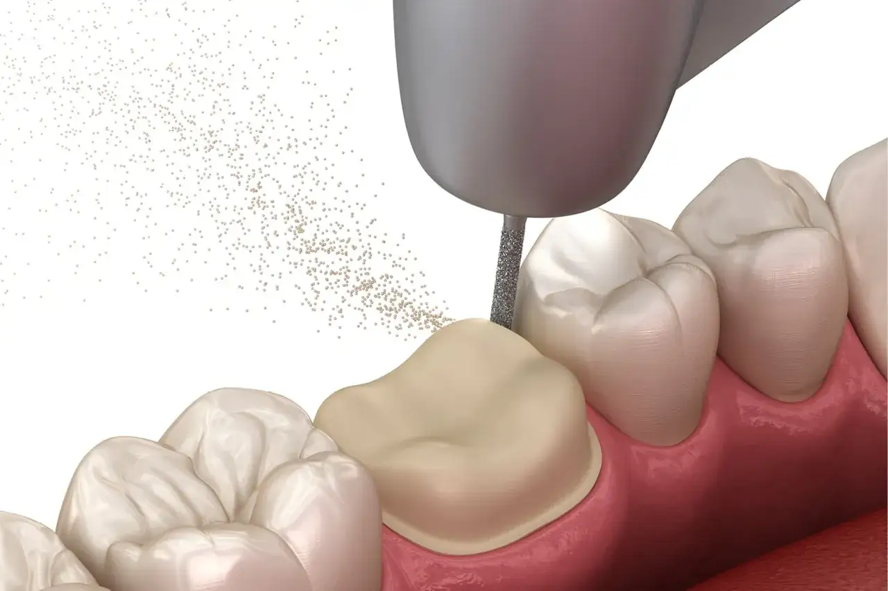 Un diente recibe un tratamiento de bopt dental. Una fresa dental pule la superficie del diente, liberando peque&ntilde;as part&iacute;culas.