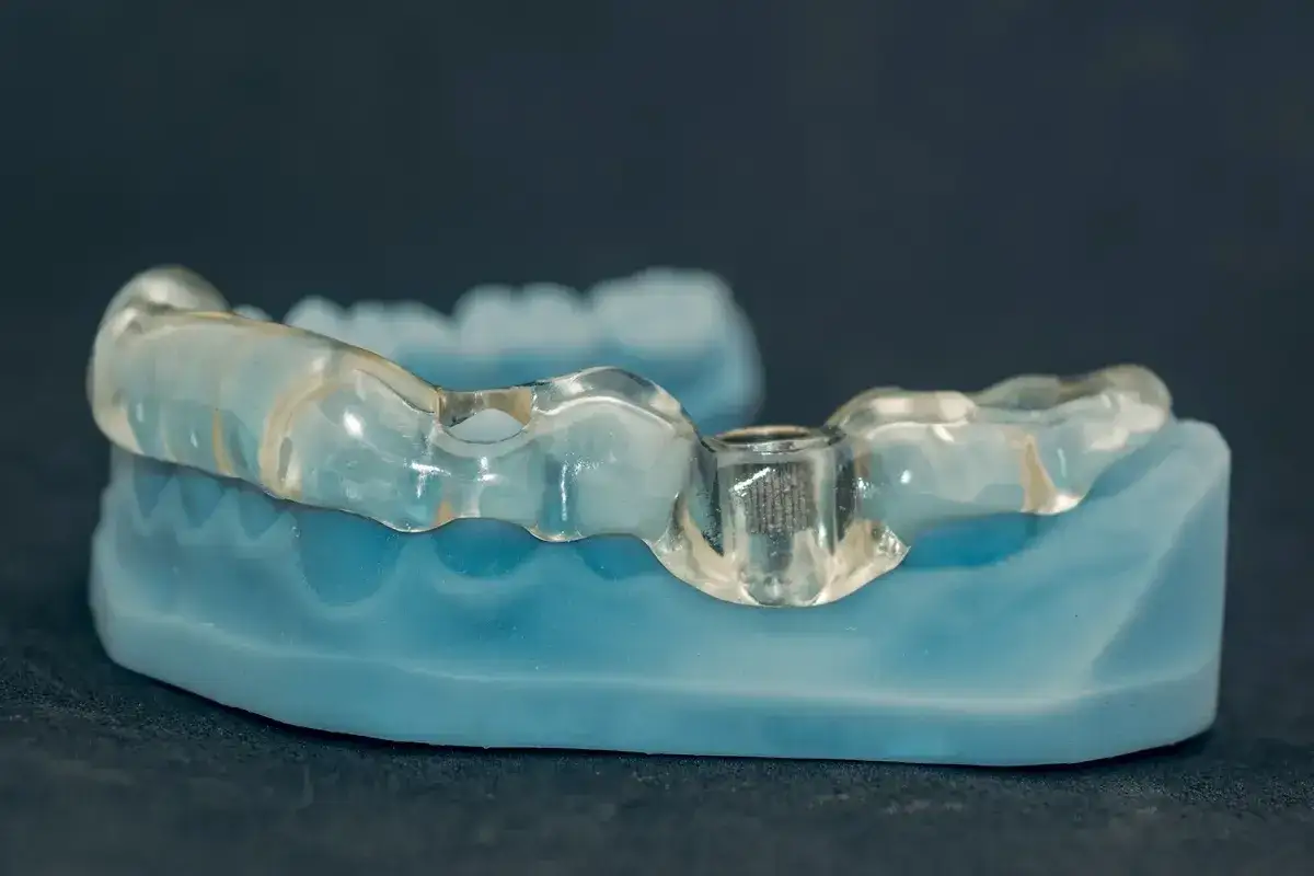 Guida trasparente su modello dentale blu, essenziale per la chirurgia guidata dentale di precisione.