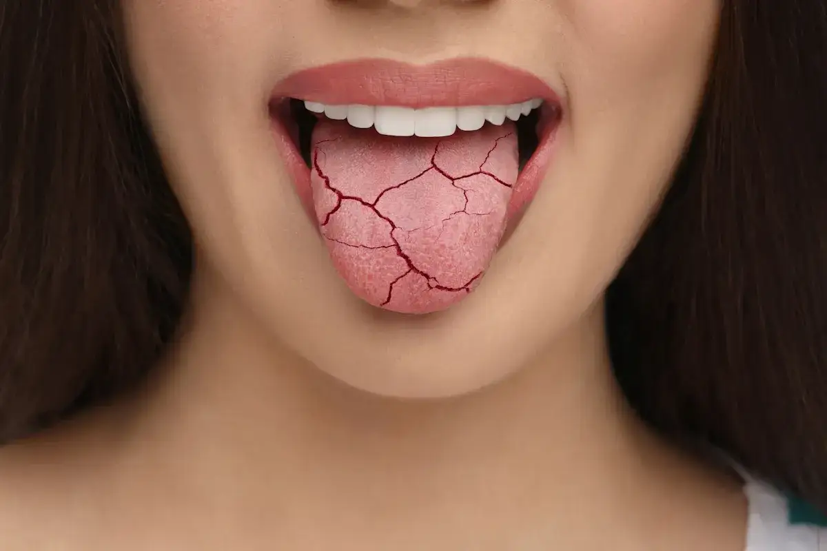 Lingua screpolata, un possibile sintomo di labbra secche diabete.