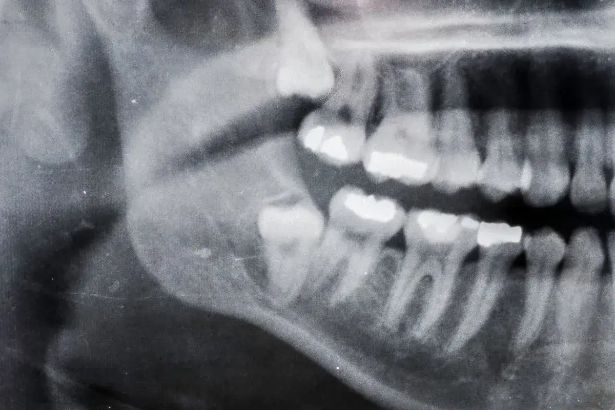 Radiografia dentale mostra un dente incapsulato che fa male, con segni di otturazioni sui denti adiacenti.