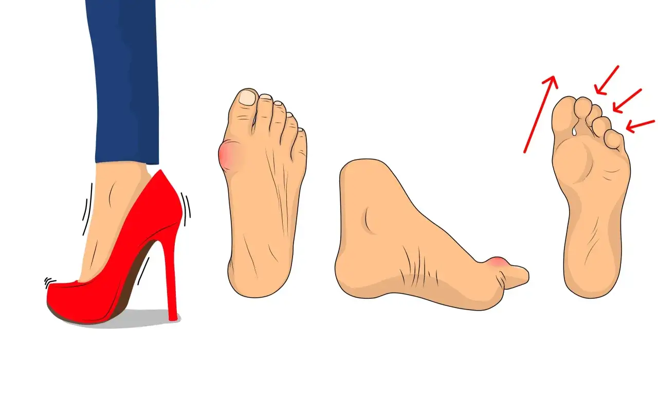 Hohe Absätze können zu Problemen wie Senk spreizfuß führen. Die Abbildungen zeigen einen Fuß in einem roten High Heel, einen Ballen, einen Hammerzeh und die Zehenstellung.