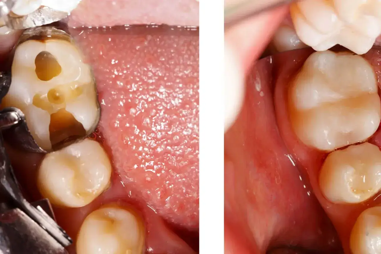 Diente con empaste caído y cavidad visible. Al lado, el mismo diente restaurado, luciendo sano y completo.