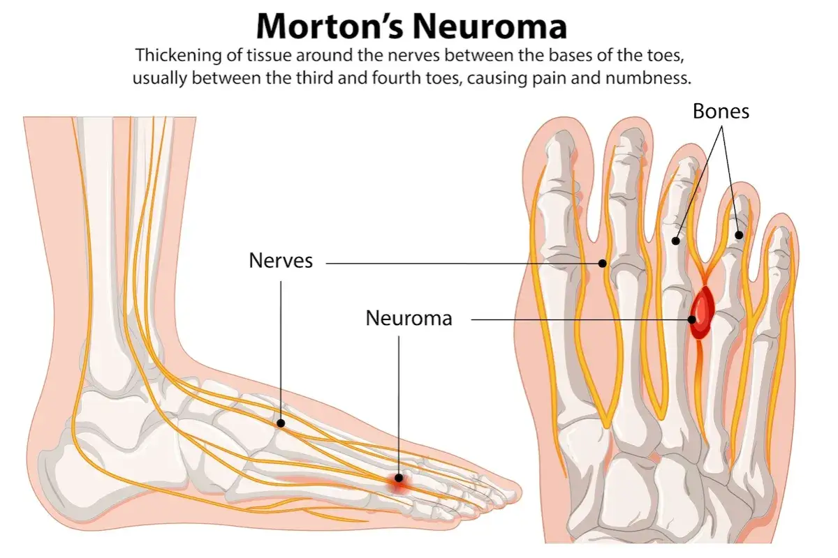Anatomia stopy z zaznaczonym nerwem i neuroma, powodującą drętwienie palca u stopy.