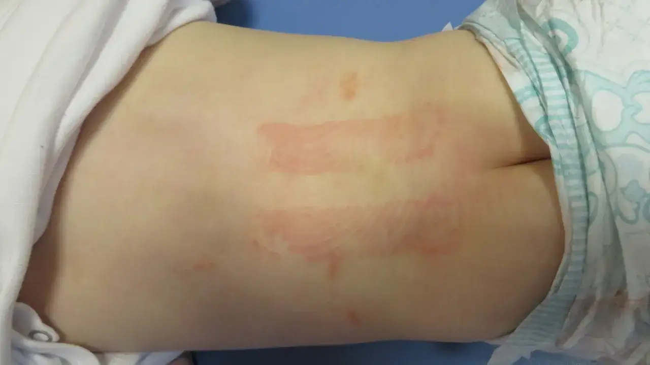 Sk&oacute;ra dziecka z zaczerwienieniem i śladami po plastrach, możliwe kinesiotaping skutki uboczne.