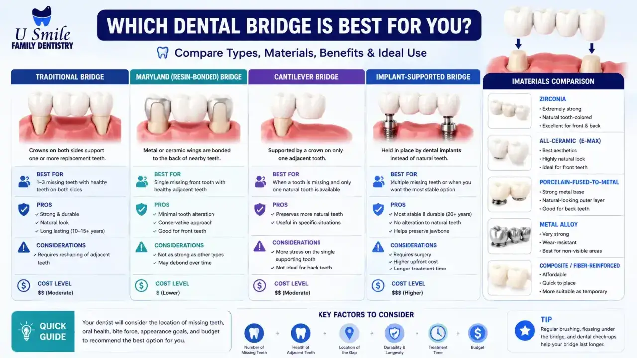 Confronto tra ponti dentali: tradizionale, Maryland, a sbalzo e supportato da impianti. Un ponte di Toronto è un'opzione.