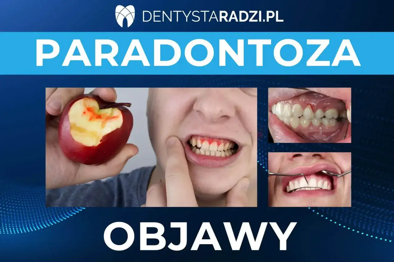 Objawy parodontozy: krwawiące dziąsła po ugryzieniu jabłka, odsłonięte szyjki zębów i cofające się dziąsła.
