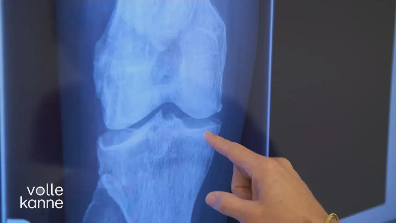 R&ouml;ntgenbild eines Knies, das eine Knie Distraktion zeigt. Ein Finger deutet auf den Bereich zwischen den Knochen.