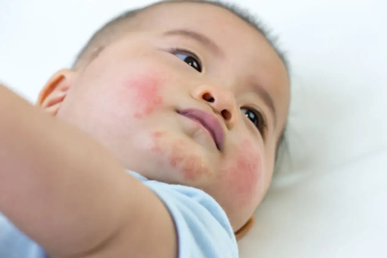 Visage d'un b&eacute;b&eacute; avec des rougeurs et des plaques, possiblement une allergie pollen visage.
